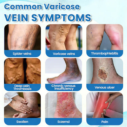 🇨🇦🏆COUGEX® VascuCare Vein Healing Spray(Designed for Varicose veins, Spider veins, Deep vein Thrombosis, Chronic venous insufficiency, Venous ulcers, Thrombophlebitis and other venous issues)