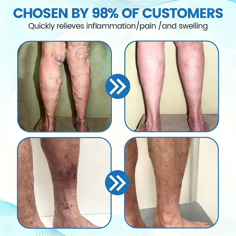 🇨🇦🏆COUGEX® VascuCare Vein Healing Spray(Designed for Varicose veins, Spider veins, Deep vein Thrombosis, Chronic venous insufficiency, Venous ulcers, Thrombophlebitis and other venous issues)