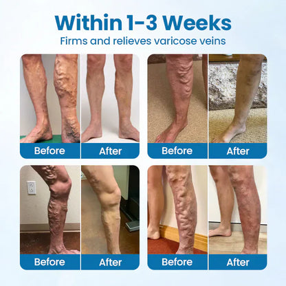 Purekin VeinTarget Microneedle Patch