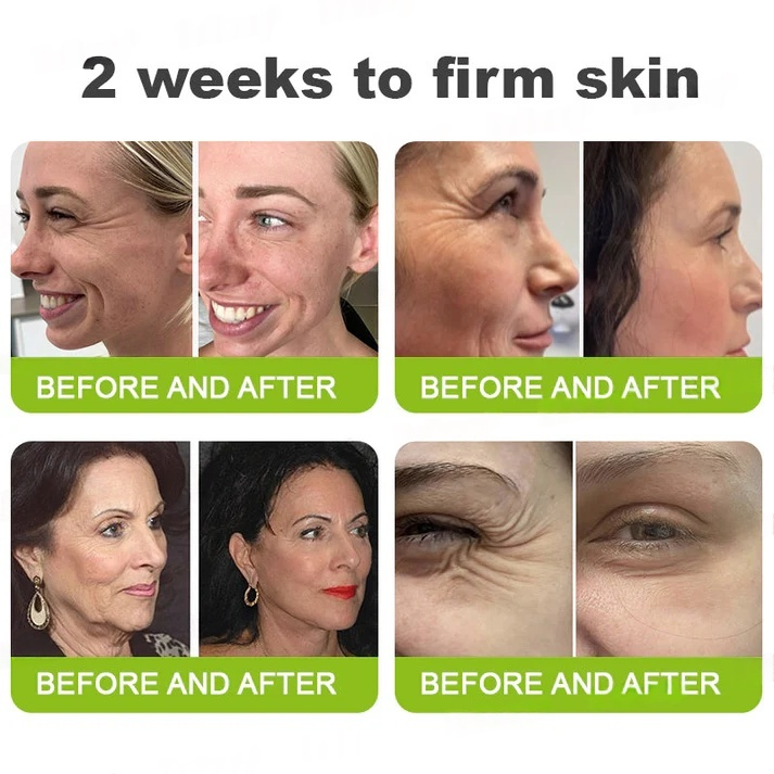 Final 3 Hours: 70%OFF🔥Botulinum & Vita-A Retinol Shot Wrinkle-Lift Tightening cream✨