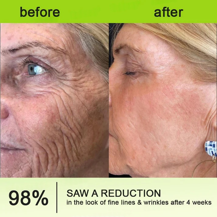 Final 3 Hours: 70%OFF🔥Botulinum & Vita-A Retinol Shot Wrinkle-Lift Tightening cream✨
