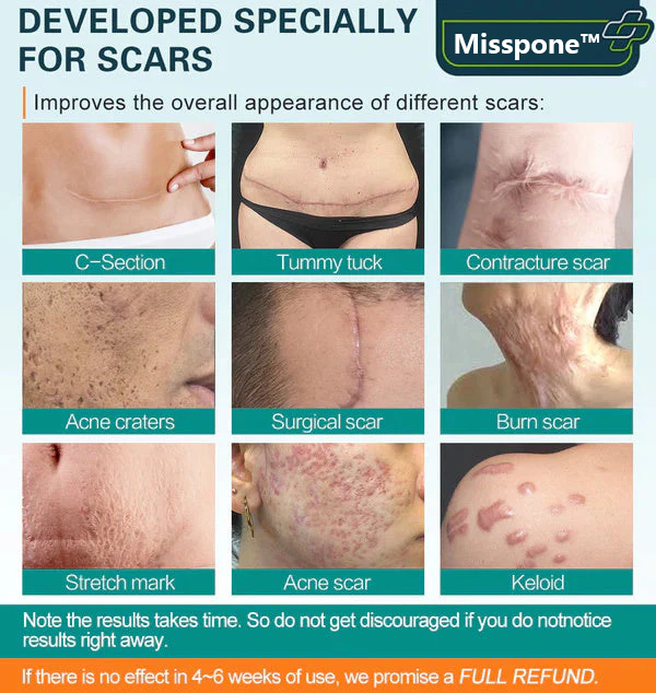 ❤️Misspone™ Advanced Scar Spray For All Types of Scars - For example Acne Scars, Surgical Scars and Stretch Marks