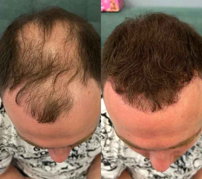 Misspone™ - Revive Your Hairline Powder