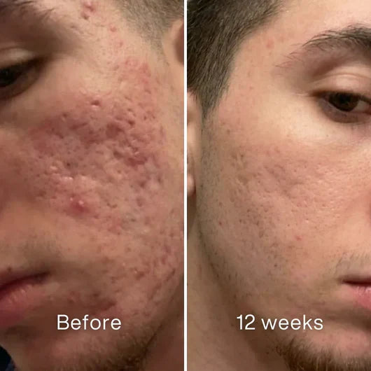 Jaxvolt™Clinical Acne Scar Remodeling Stick