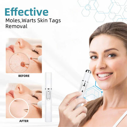 Purekin VelvetSkin+ Medical-Grade Laser Pen (Powered by CO2 laser technology – effectively removes moles, warts, skin tags, pigmentation spots, and other skin imperfections)