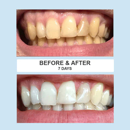 SmileFitPro Advanced Teeth Whitening Kit