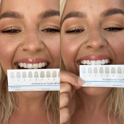 SmileFitPro Advanced Teeth Whitening Kit